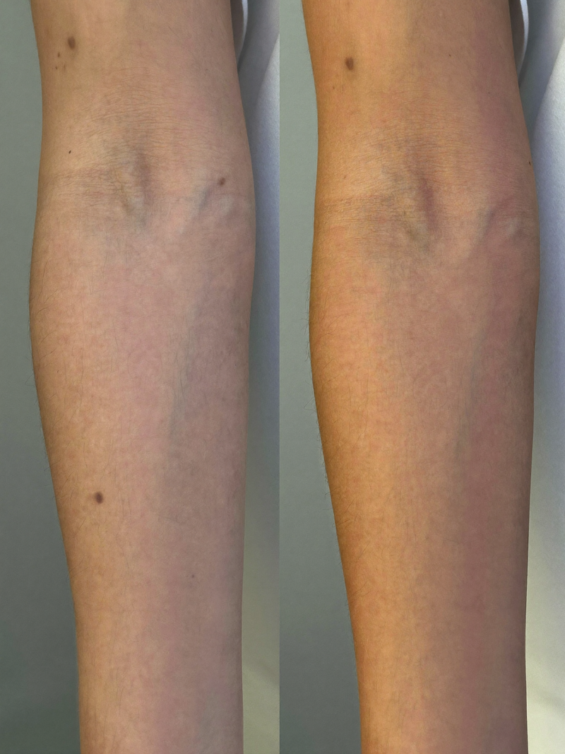 Result forearm before and after
