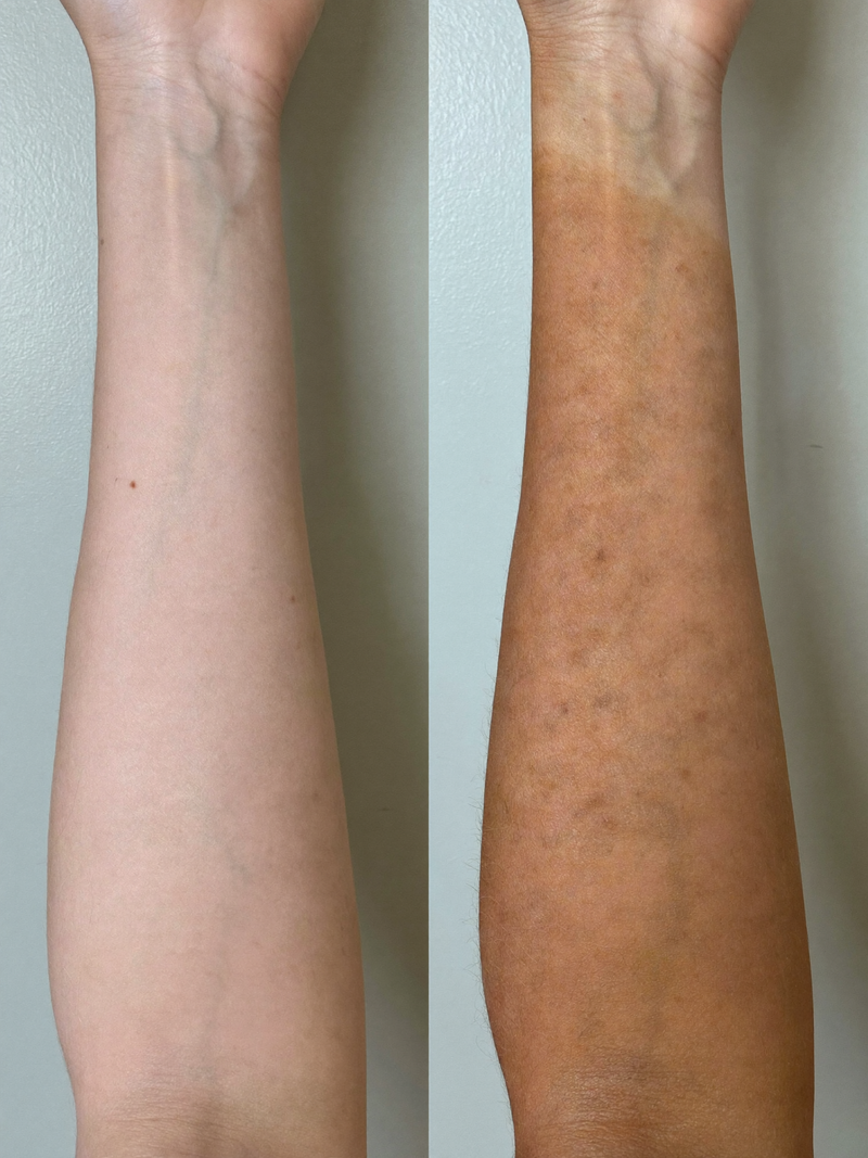 Result porcelain arm before and after
