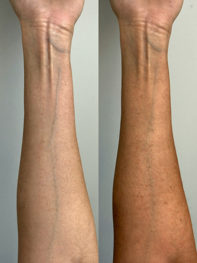 Result mature arm before and after